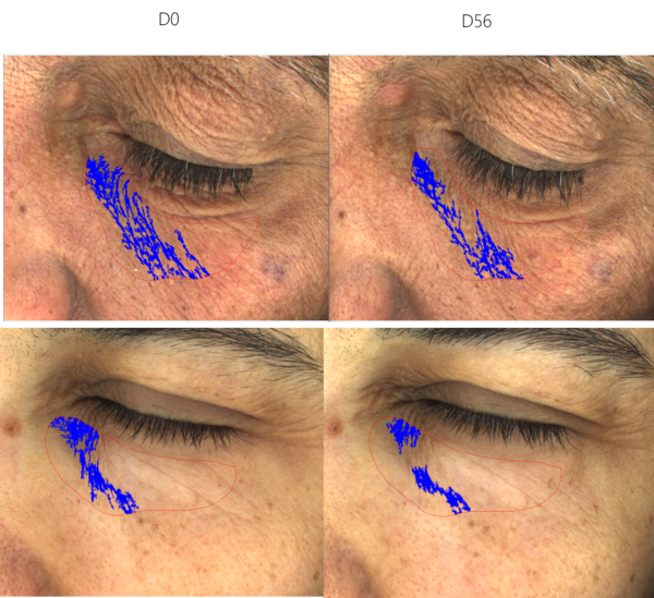 canaldis-HDcosmetic-melantxa-contorno-de-ojos-eficacia